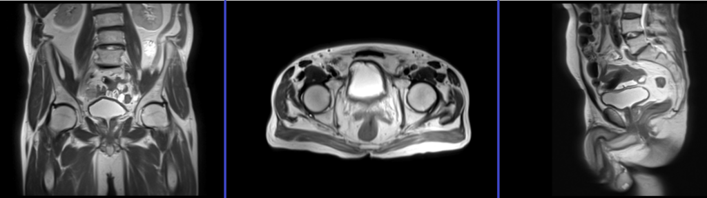 MRI musculoskeletal pelvis localiser image