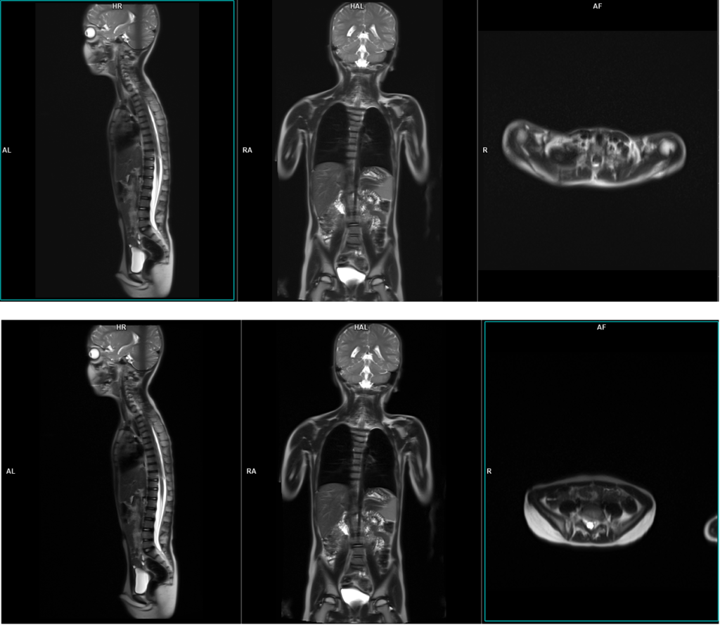 MRI pediatric whole spine localiser image