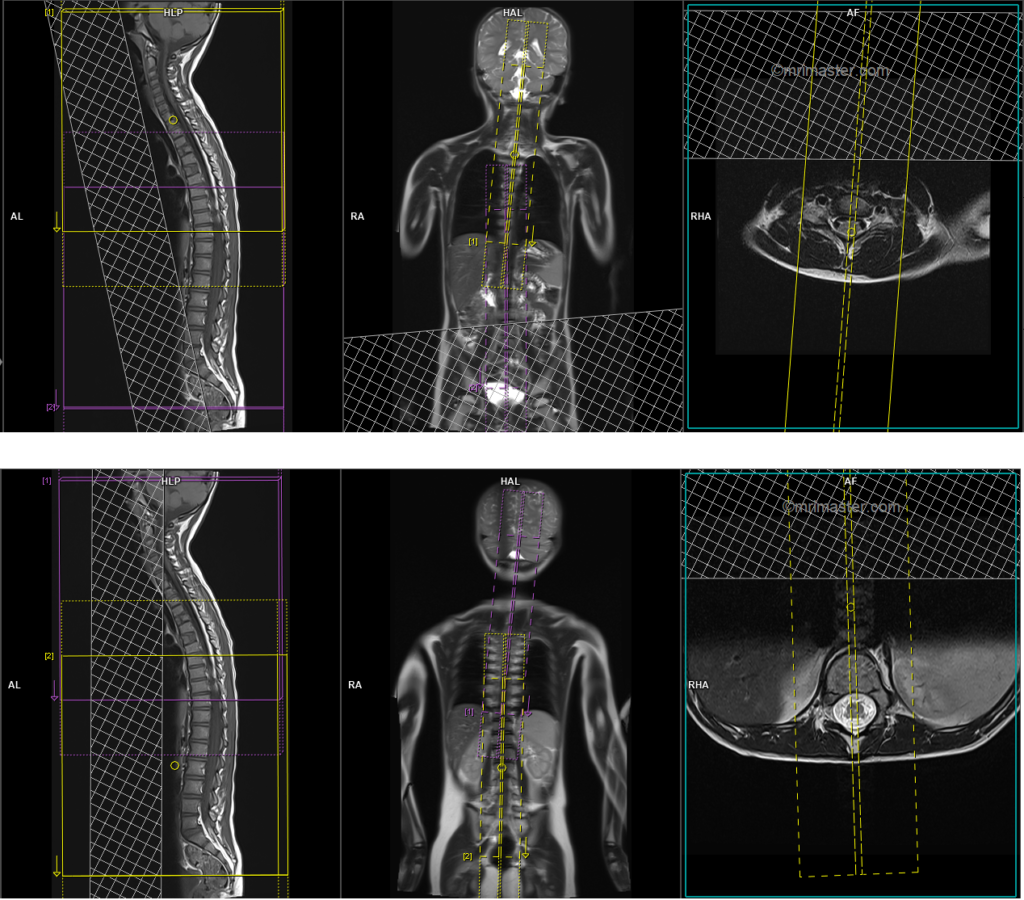 MRI pediatric whole spine sagittal scan planning and protocol image