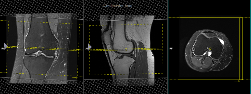 MRI planning of knee axial