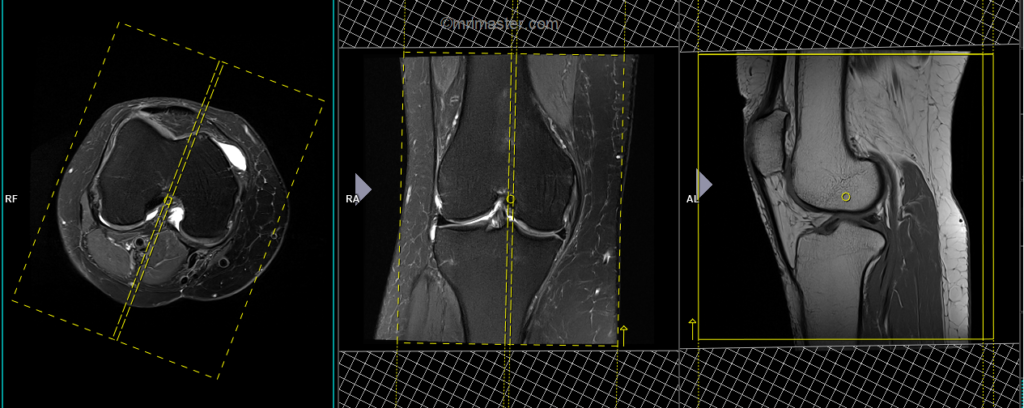 MRI planning of knee sagittal