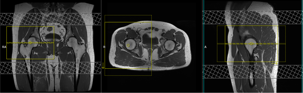 MRI unilateral hip planning of axial scans