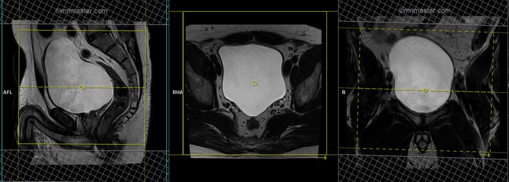 MRI urinary bladder planning and protocol of axial dynamic scans
