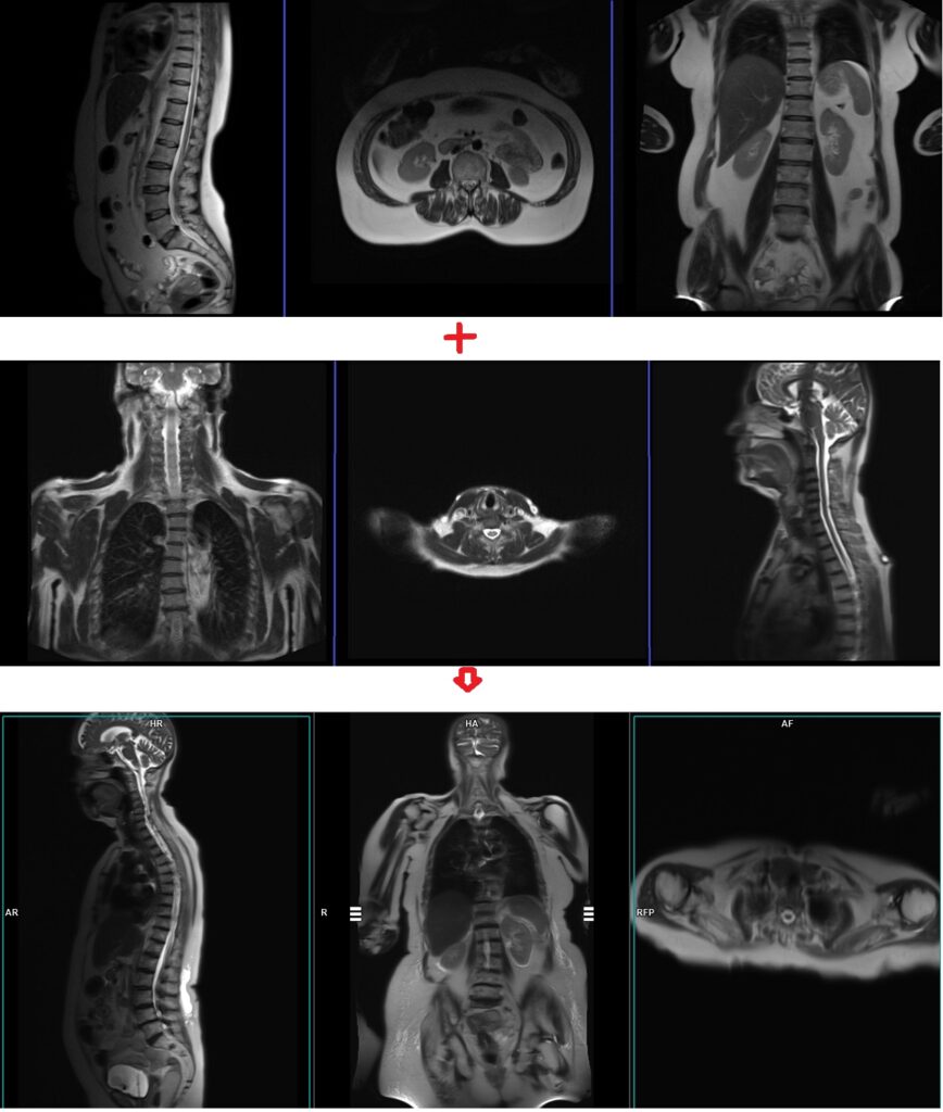 MRI whole spine automatic composing localiser
