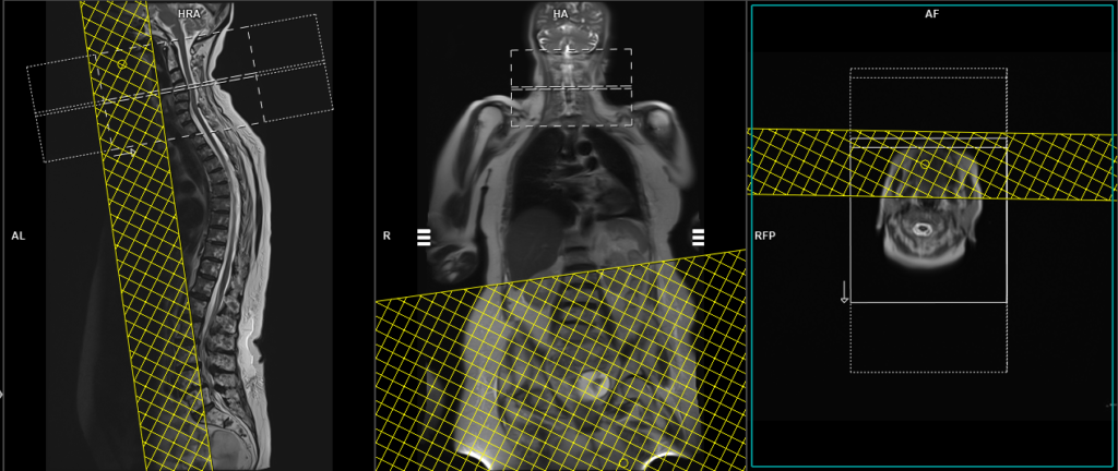 MRI whole spine automatic composing planning of axial cervical spine
