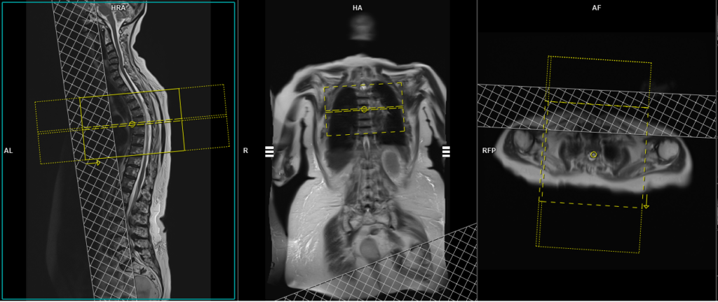 MRI whole spine automatic composing planning of axial thoracic spine