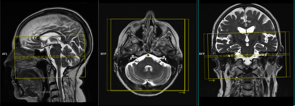 Malignant otitis externa (MOE) MRI protocols and planning of axial scans