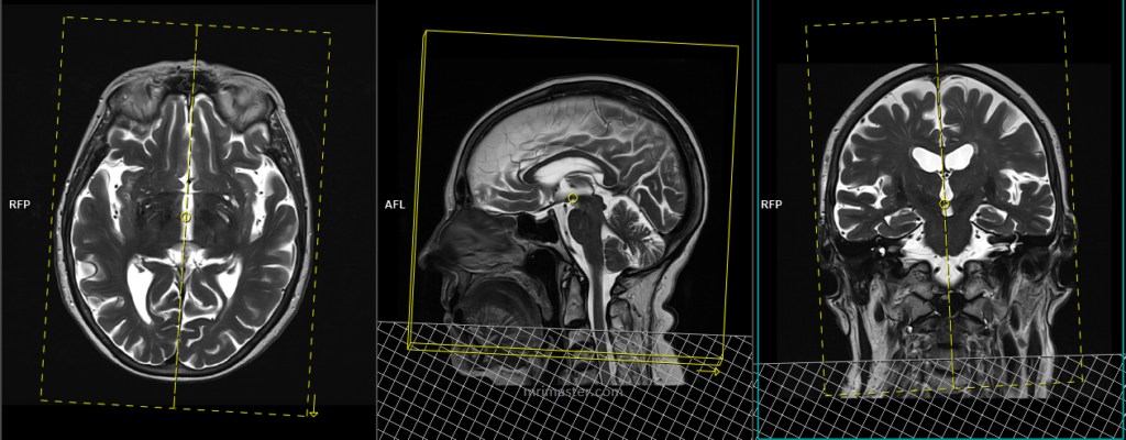 Malignant otitis externa (MOE) MRI protocols and planning of jugular vein and cavernous sinus