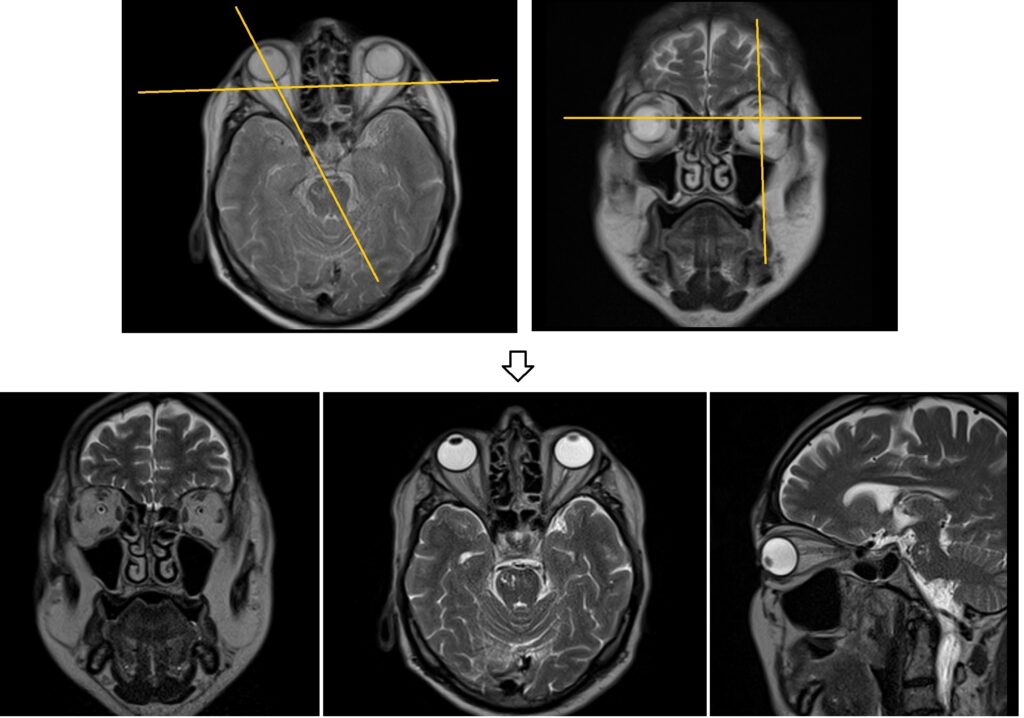 Orbit MRI localiser planning image