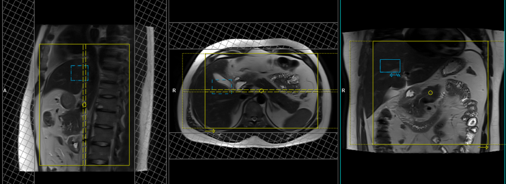 PANCREAS MRI (respiratory gated) coronal scan protocol and planning image