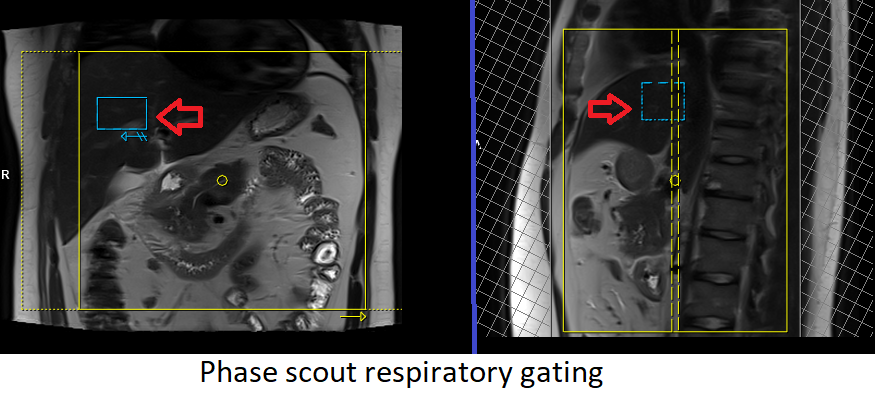 Phase scout respiratory gating how to do