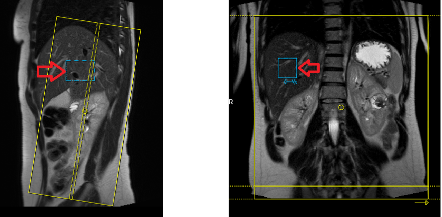 Phase scout respiratory gating in kidney imaging