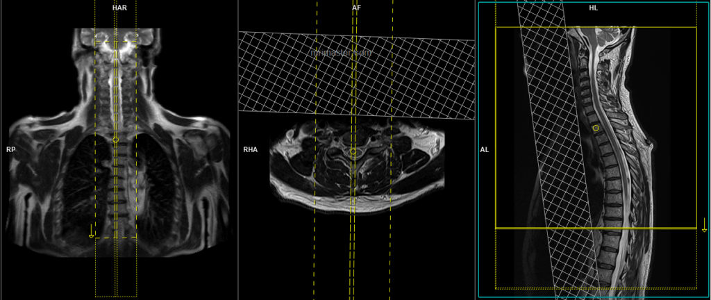 Whole spine MRI planning and protocol of cervico thoracic spine sagittal