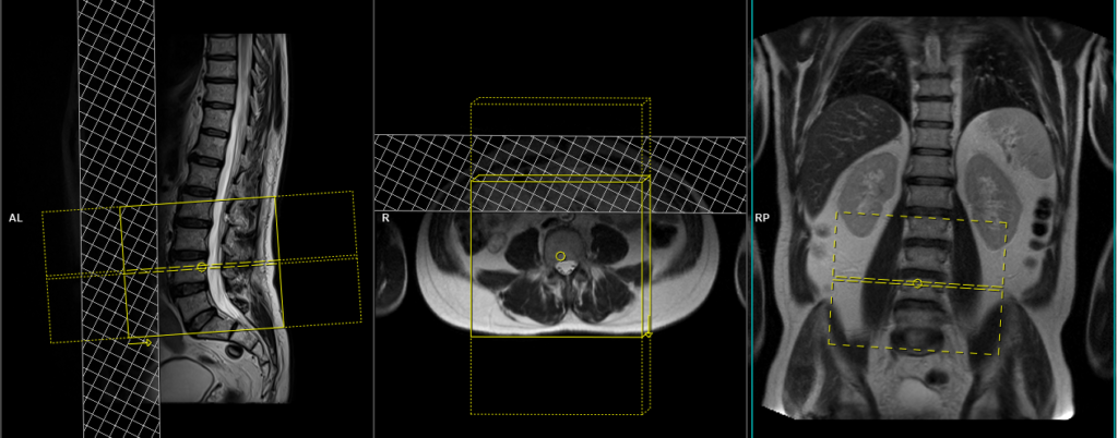 MRI planning and protocol of lumbar spine axial block