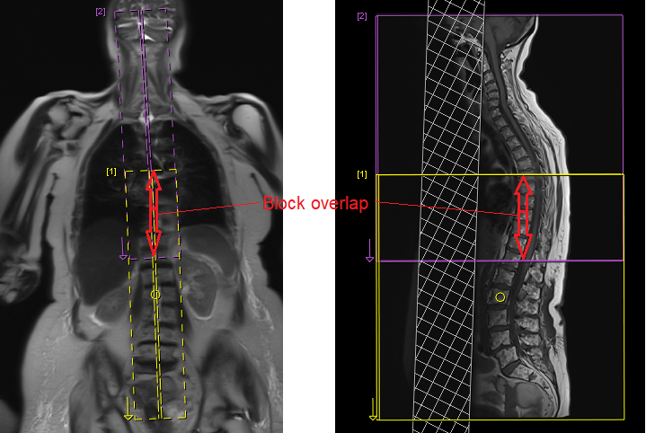 block overlap in whole spine imaging