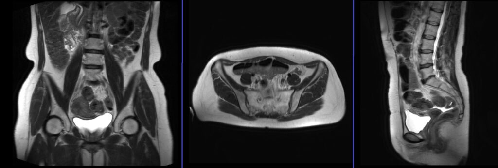 endometriosis mri localiser image