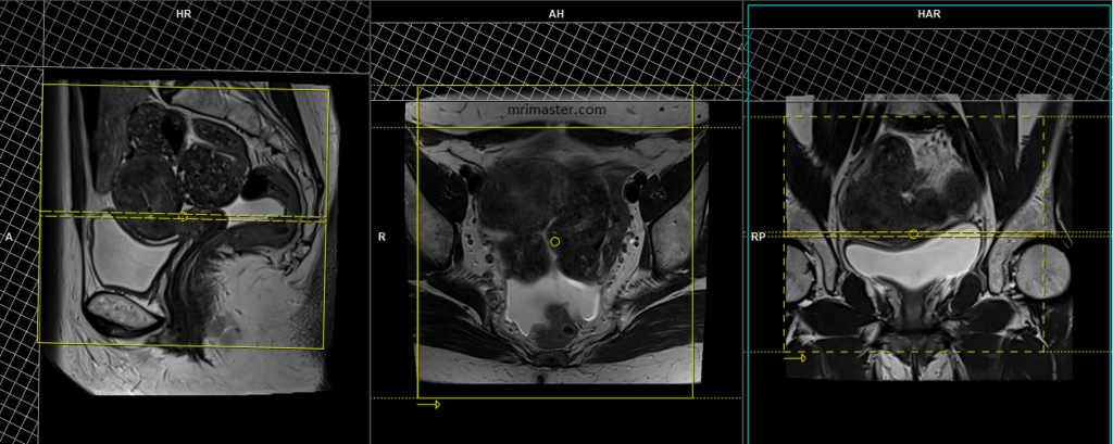 endometriosis mri protocol and planning of axial scans