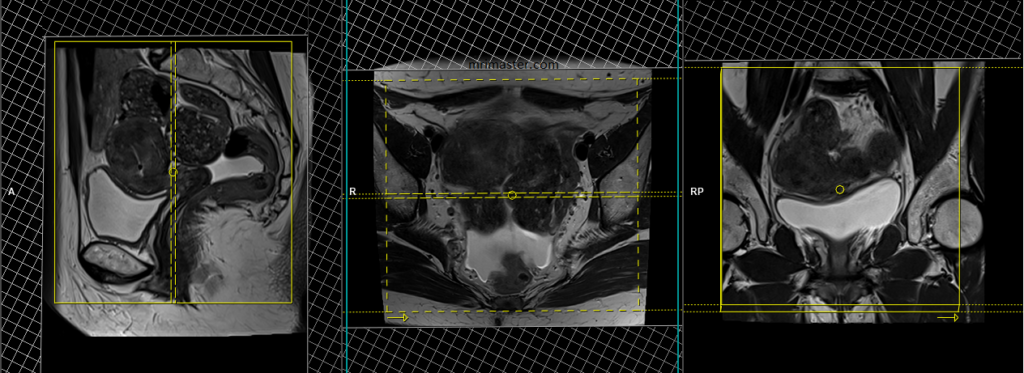 endometriosis mri protocol and planning of coronal scan