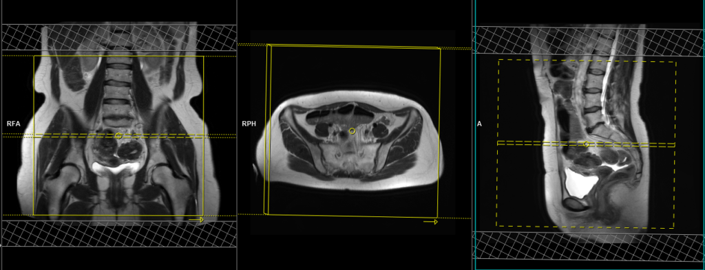 endometriosis mri protocol and planning of large fov axial images