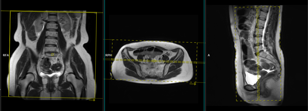 endometriosis mri protocol and planning of large fov coronal images