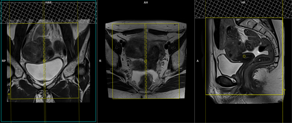 endometriosis mri protocol and planning of saittal scans