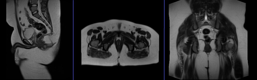 mri fistula localizer image