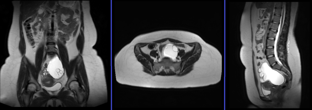 mri ovarian cancer.cyst.adnexal masses localiser image