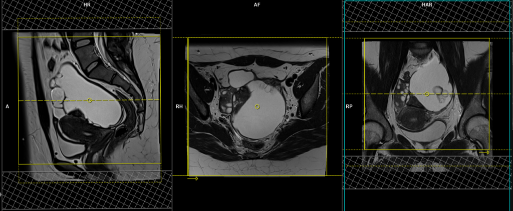 mri ovarian cancer.cyst.adnexal masses planning and protocol of axial dynamic scans