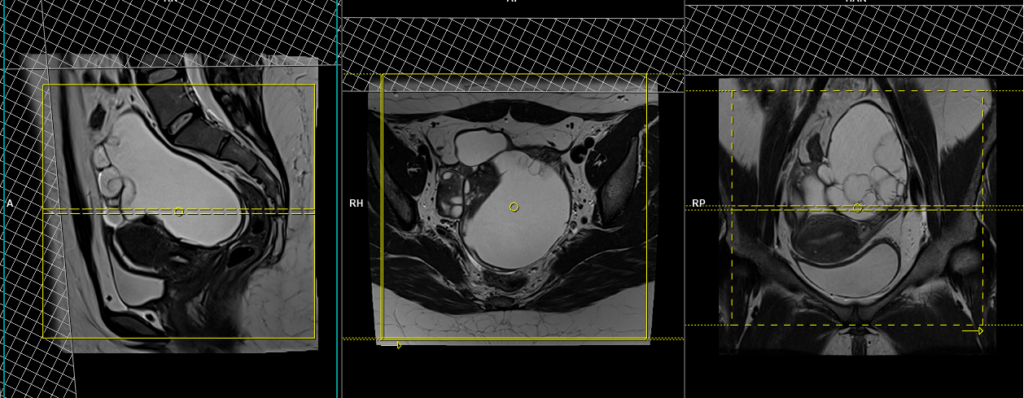mri ovarian cancer.cyst.adnexal masses planning and protocol of axial scans
