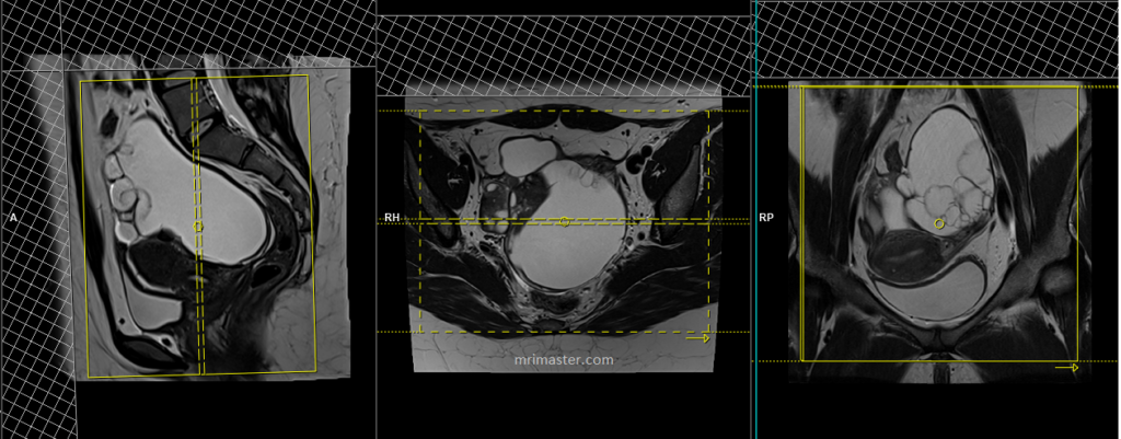 mri ovarian cancer.cyst.adnexal masses planning and protocol of coronal scans