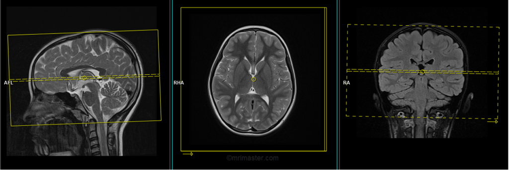 mri pediatric brain dwi axial planning