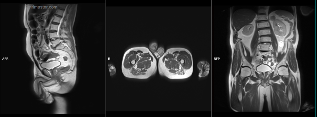 mri penis protocol and planning localiser image