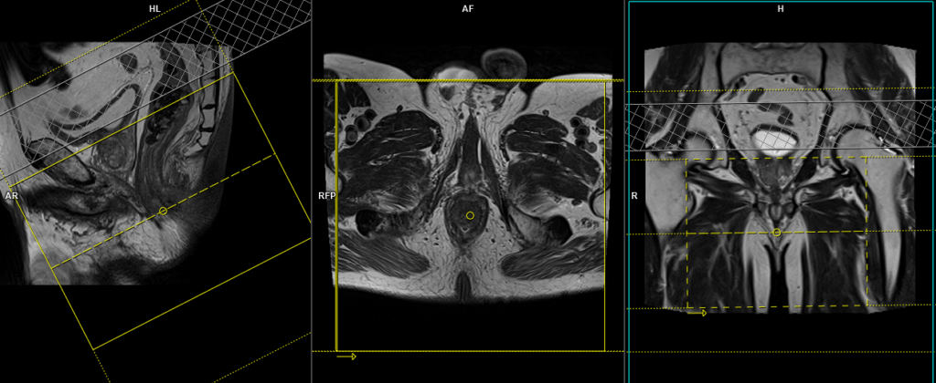 mri perianal fistula with contrast planning and protocol of 3d T1 DIXON scans