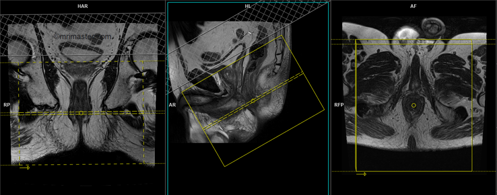 mri perianal fistula with contrast planning and protocol of axial scans