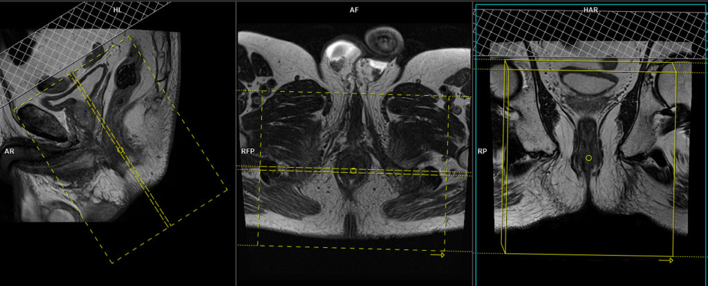 mri perianal fistula with contrast planning and protocol of coronal scans