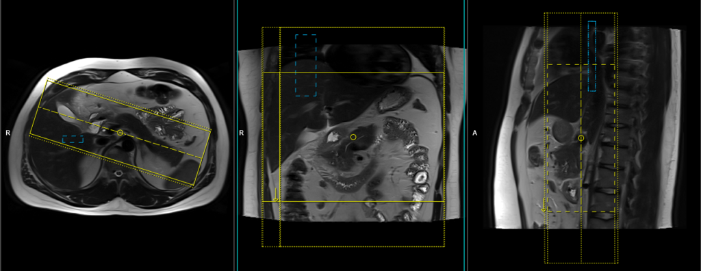 mri planing of coronal gated scans of pancreas