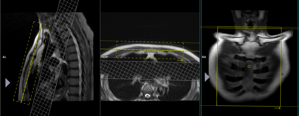 mri planning for strnum coronal scans