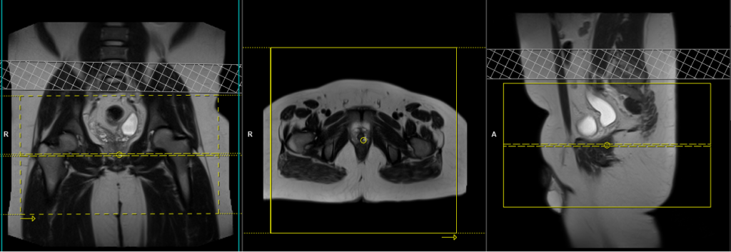 mri sports hernia protocol and planing of axial groin scans