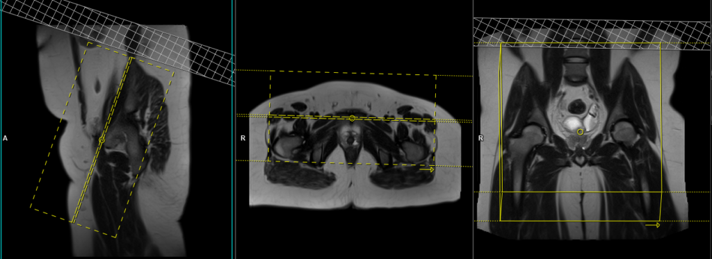 mri sports hernia protocol and planing of axial oblique scans