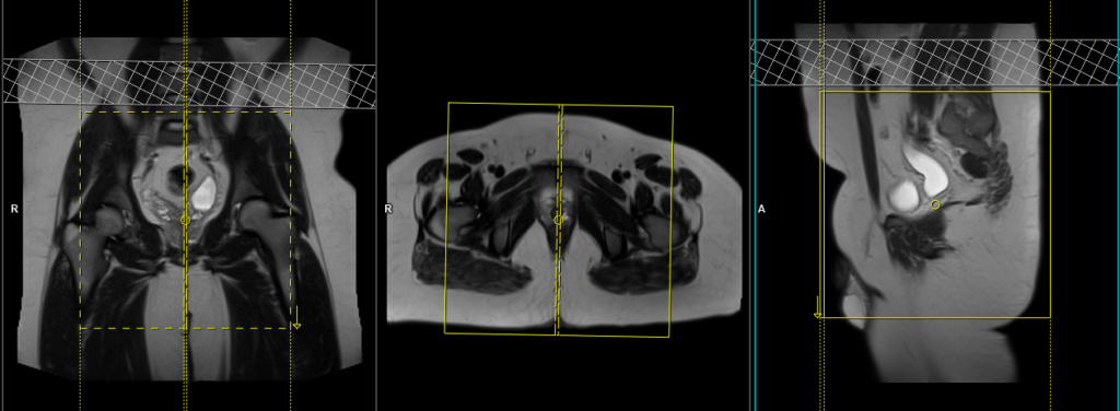 mri sports hernia protocol and planing of sagital scans