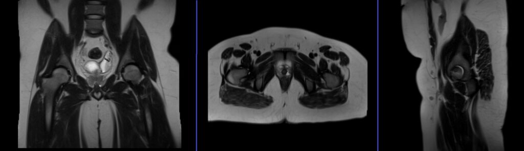 mri sports hernia protocol localiser scan