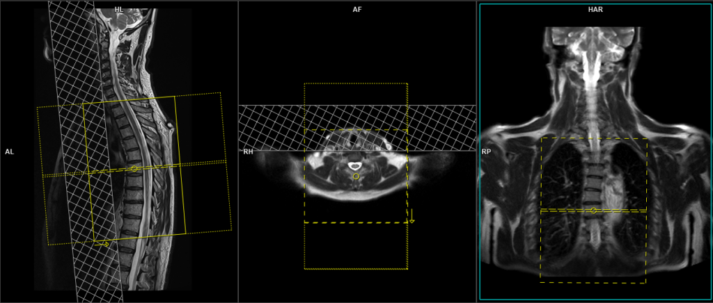 mri t spine planning of axial