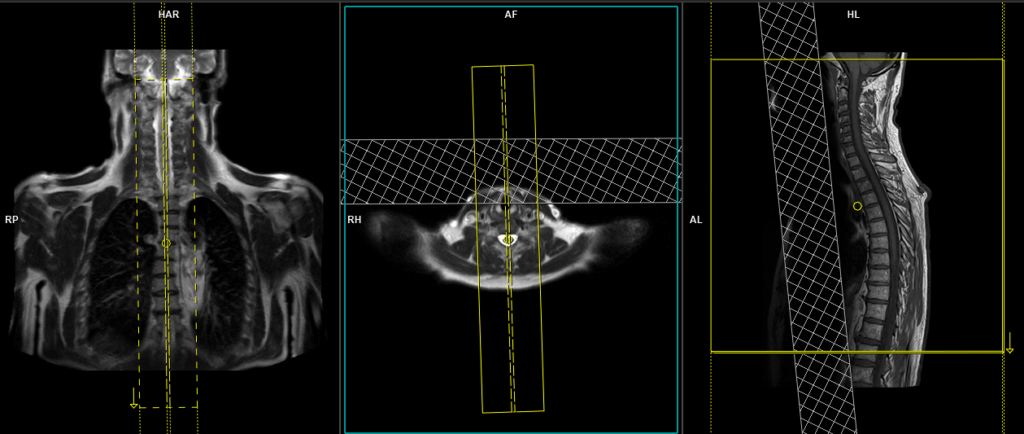 mri t spine planning of sagittal