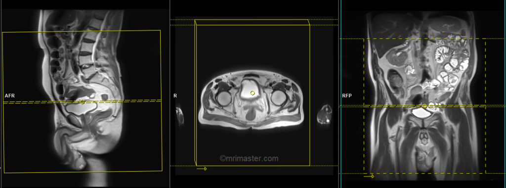 MRI testis axial large FOV abdomen and pelvis planning image