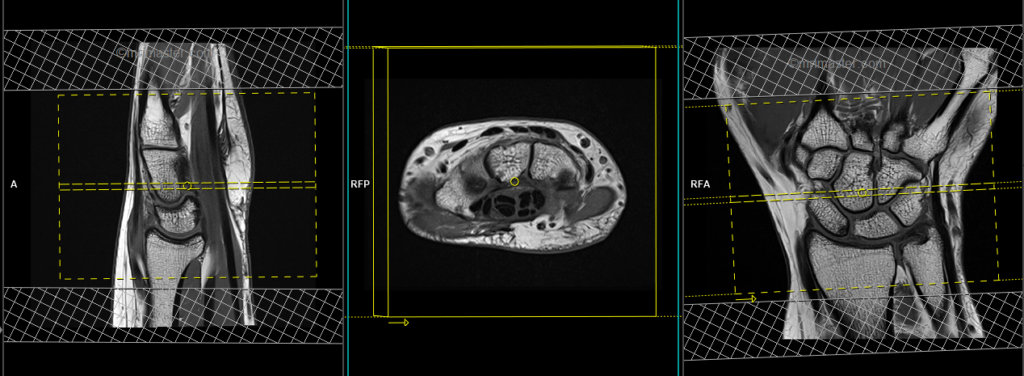 mri wrist planning of axial images
