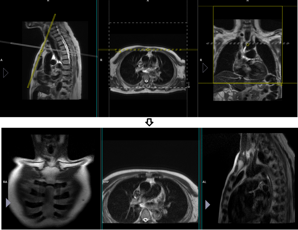 sternoclavicular joint mri planning localiser