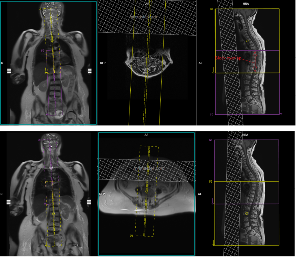 whole spine automatic composing sagittal scan planning