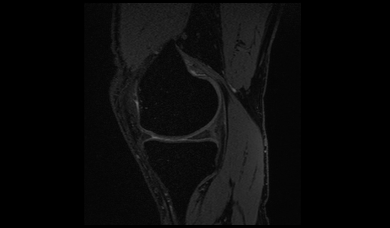 DESS image knee
