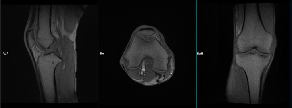 Knee MRI localiser image