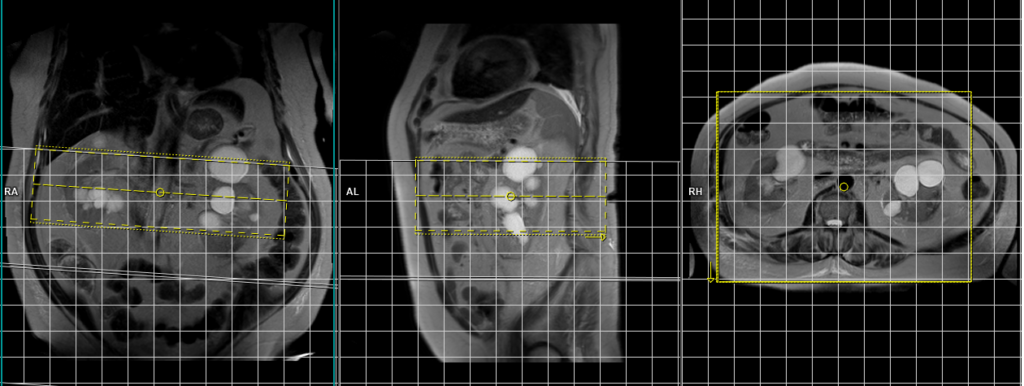 MRA NATIVE non contrast renal artery scan planning and protocol